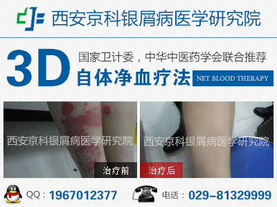 咸阳治疗牛皮癣的最好医院
