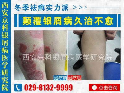 咸阳牛皮癣治疗最好的医院